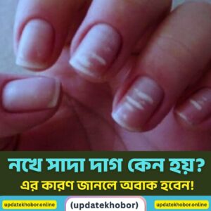 নখে সাদা দাগ কেন হয়? এর কারণ জানলে অবাক হবেন!